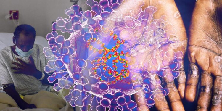 BM'den maymun çiçeği virüsünün yerinden edilmişleri etkilememesi için dayanışma çağrısı